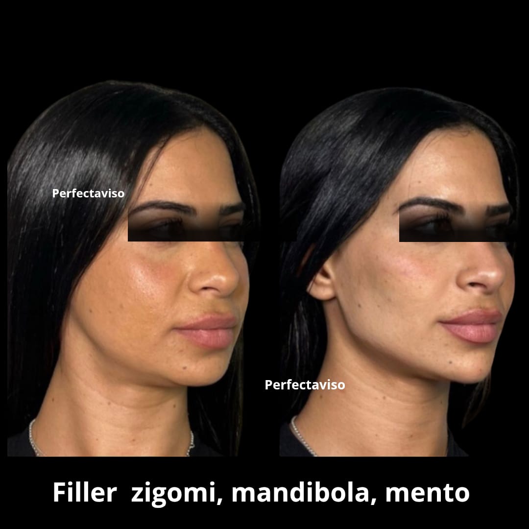 Armonizzazione Facciale Napoli: foto prima e dopo trattamento completo viso donna