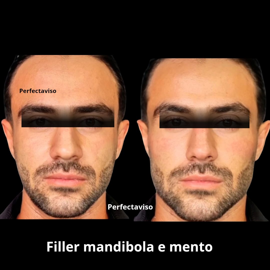 Armonizzazione facciale Napoli uomo: foto prima e dopo definizione linea mandibolare e mento eseguita dal Dr. Grippo
