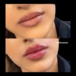 Filler labbra Napoli Dr.Vincenzo Grippo