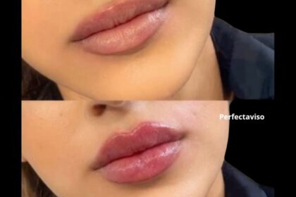 Filler labbra Napoli Dr.Vincenzo Grippo