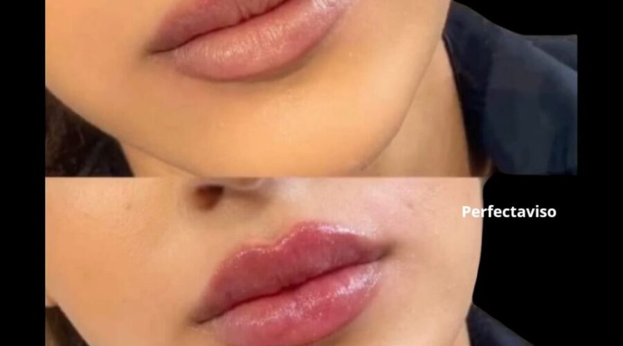 Filler labbra Napoli Dr.Vincenzo Grippo