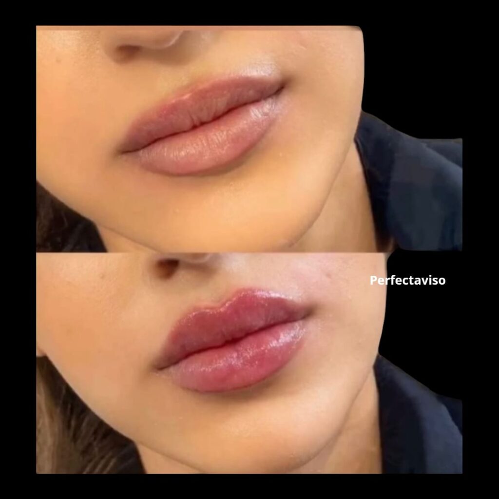 Filler labbra Napoli Dr.Vincenzo Grippo