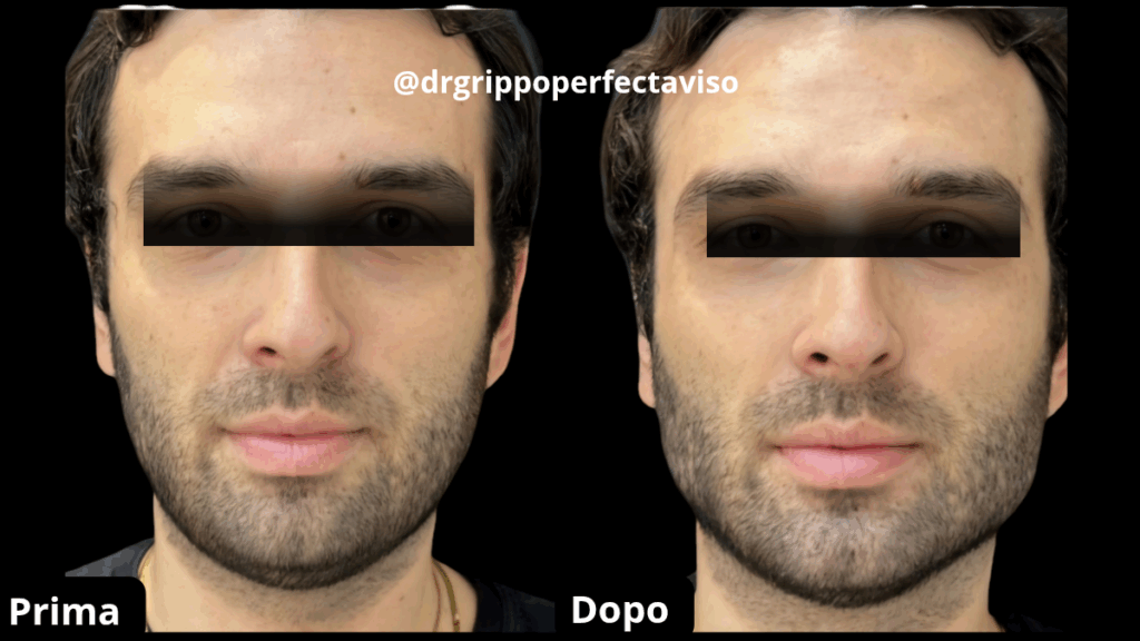 Filler mento e mandibola Napoli: foto prima e dopo trattamento uomo con tecnica Full Face