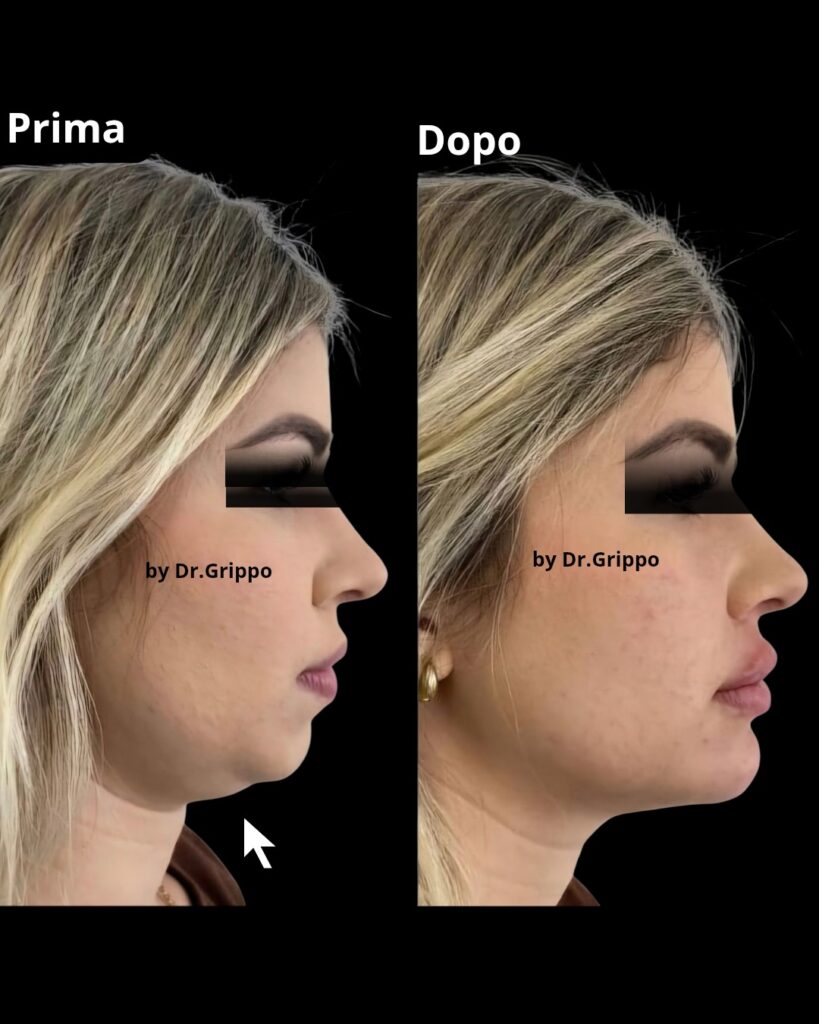 Doppio mento a Napoli: risultato prima e dopo del trattamento con Belkyra e filler mento