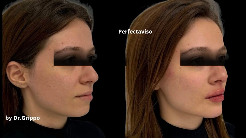 Filler Napoli: prima e dopo con acido ialuronico della tecnica Full Face del Dr.Grippo