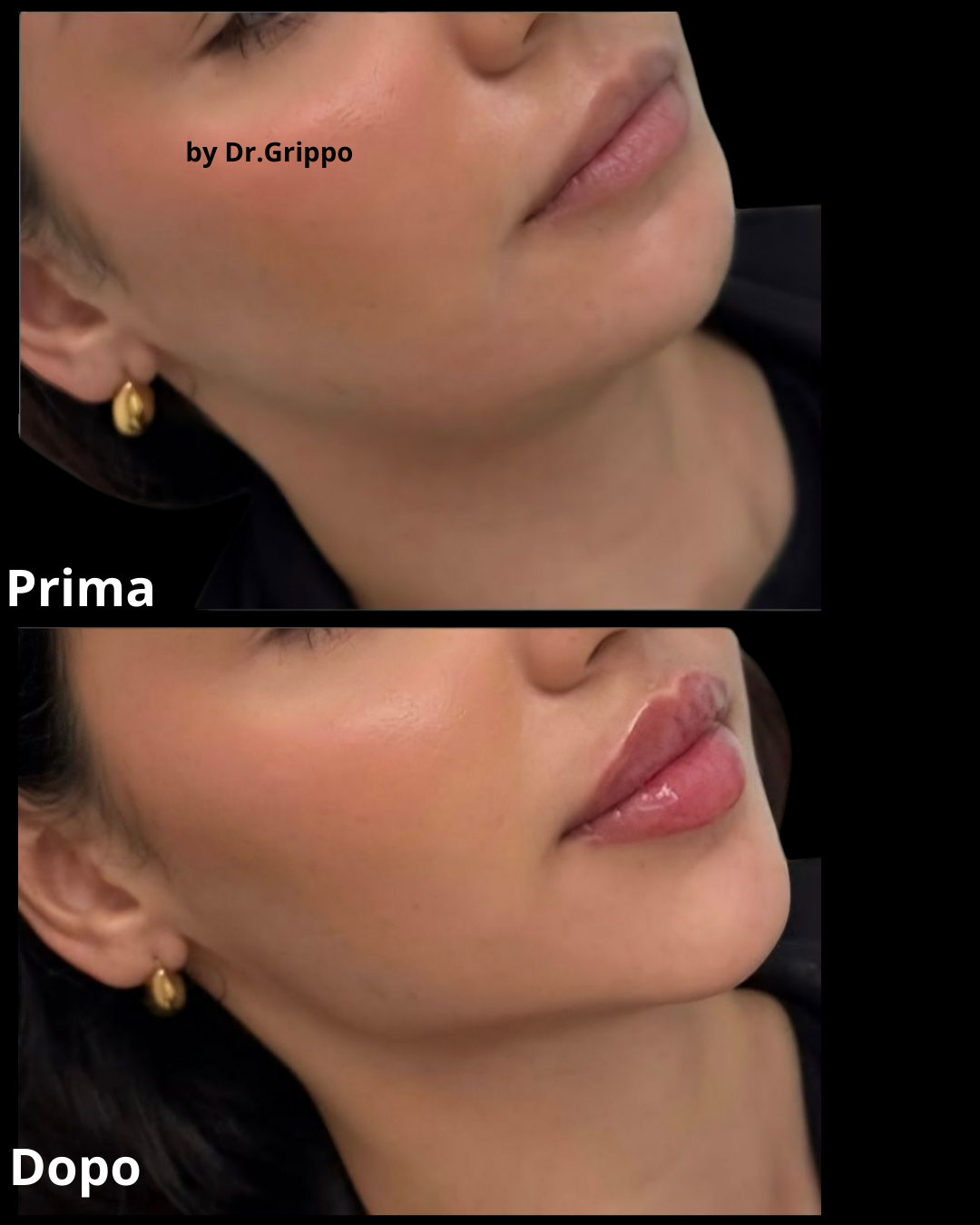 Filler Full Face Napoli – zigomi alti, linea mandibolare definita e labbra naturali