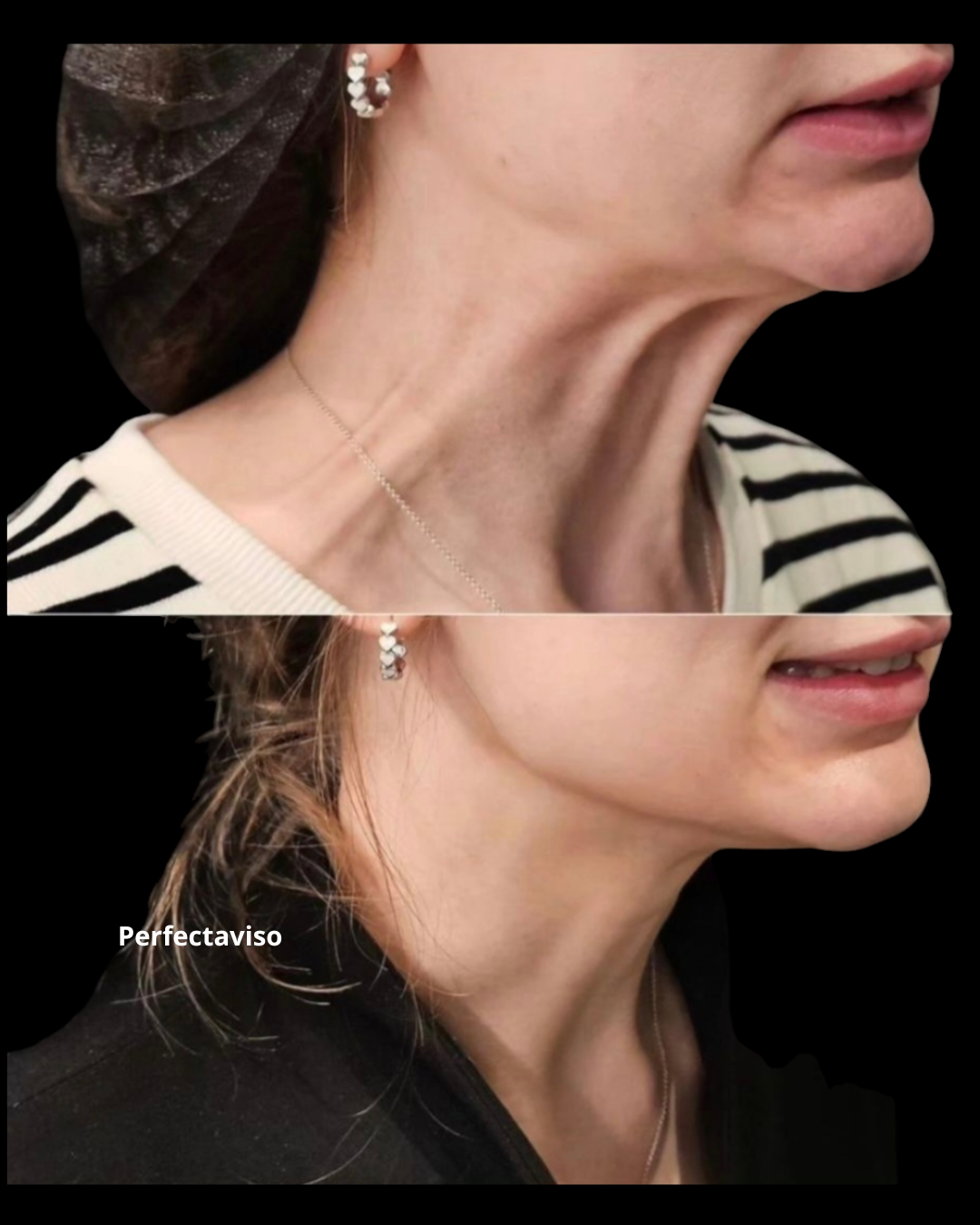 Botox Napoli con tecnica Nefertiti Lift: lifting non chirurgico del collo e della linea mandibolare