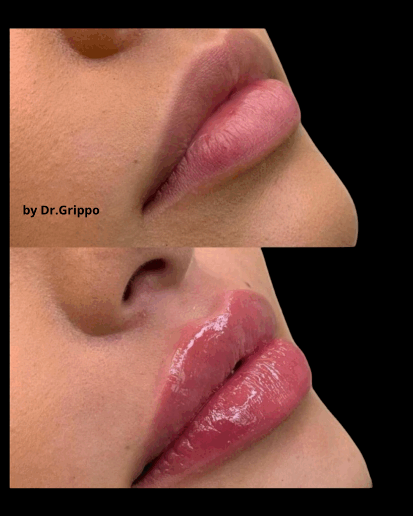 Filler labbra a Napoli aumento naturale del volume