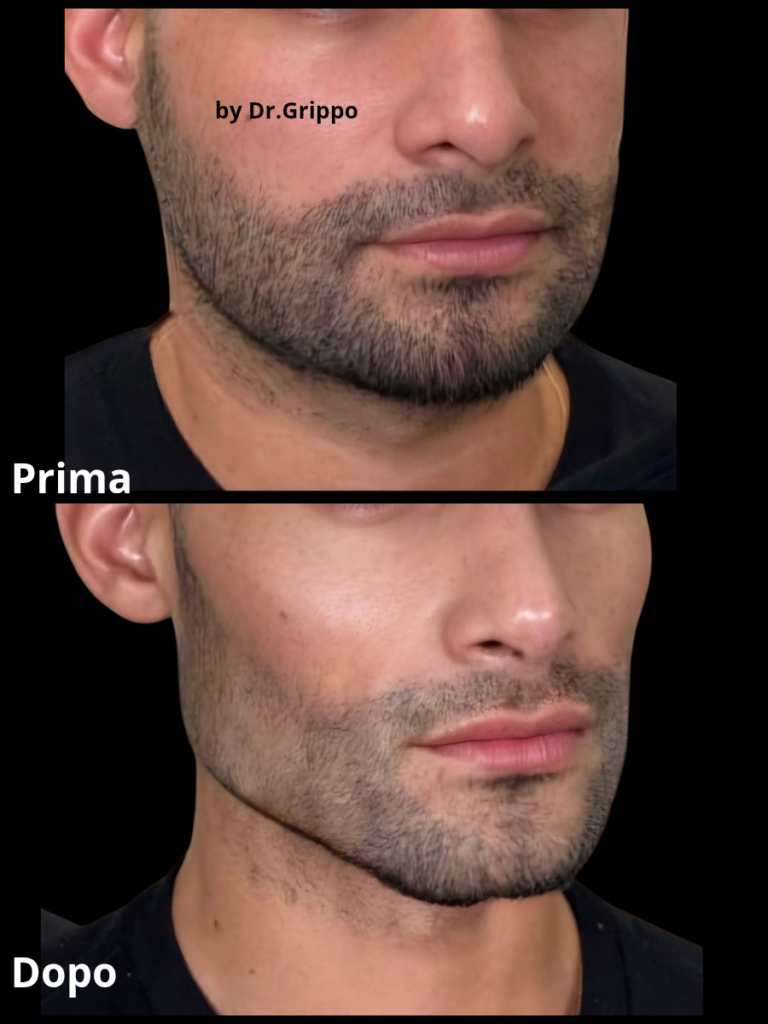 Filler mento Napoli: il ruolo chiave per definire il profilo dell'uomo
