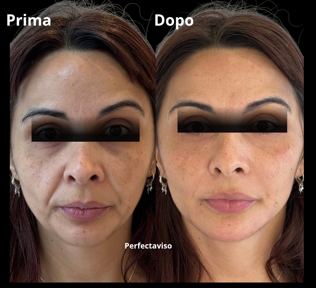 Filler Napoli: prima e dopo il trattamento eseguito dal Dr.Grippo con tecnica Full Face