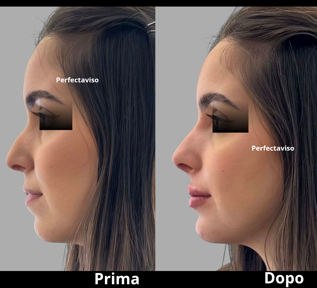 Rinofiller Napoli: profiloplastica non chirurgica eseguita dal Dr. Grippo con tecnica Full Face