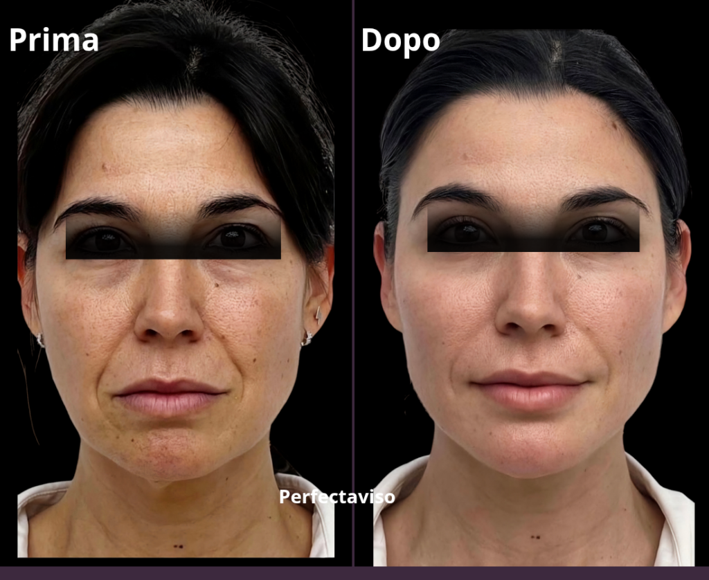 HarmonyCa Napoli: foto di prima e dopo del trattamento eseguito dal Dr.Grippo con approccio Full Face