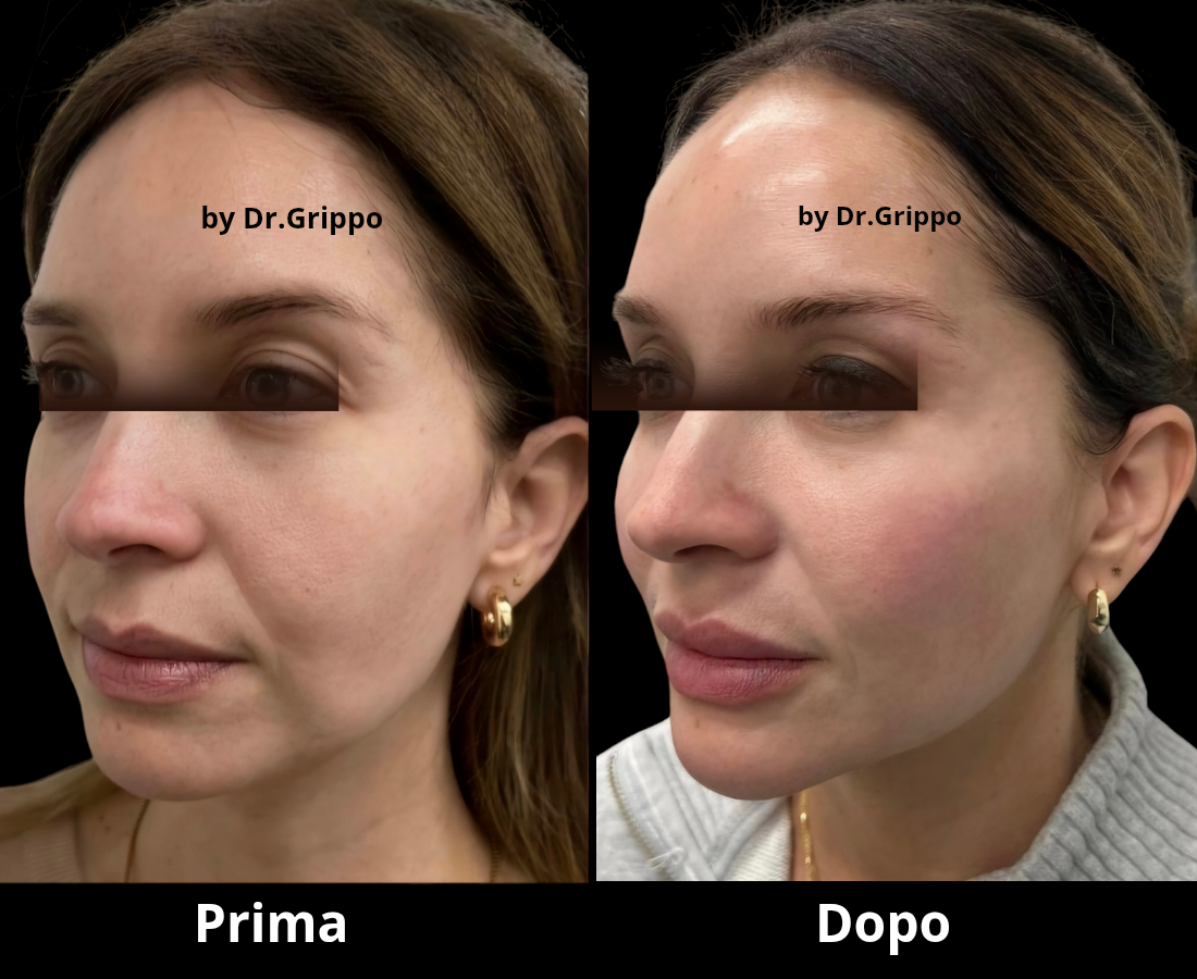 Filler zigomi Napoli: foto prima e dopo del trattamento eseguito dal Dr. Vincenzo Grippo