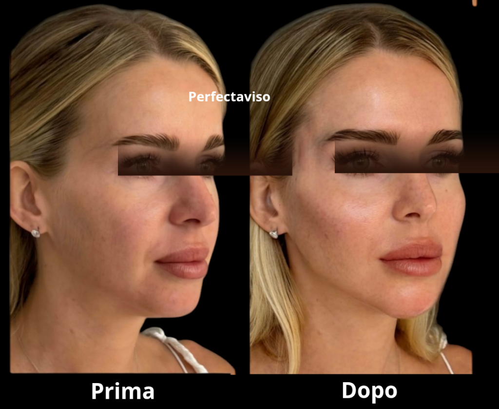 Foto prima e dopo del trattamento di armonizzazione facciale eseguito con tecniche integrate