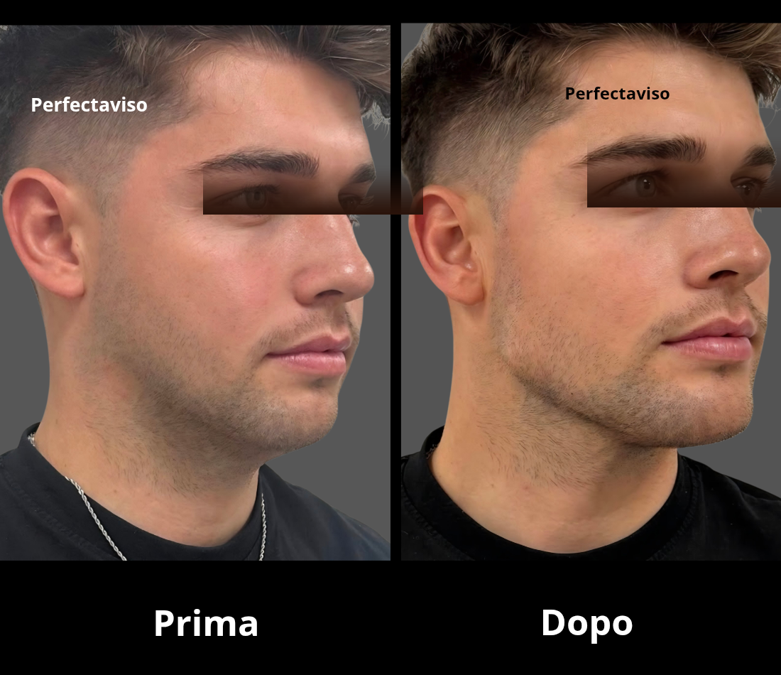 Full Face Napoli uomo: foto prima e dopo definizione linea mandibolare e mento eseguita dal Dr.Vincenzo Grippo