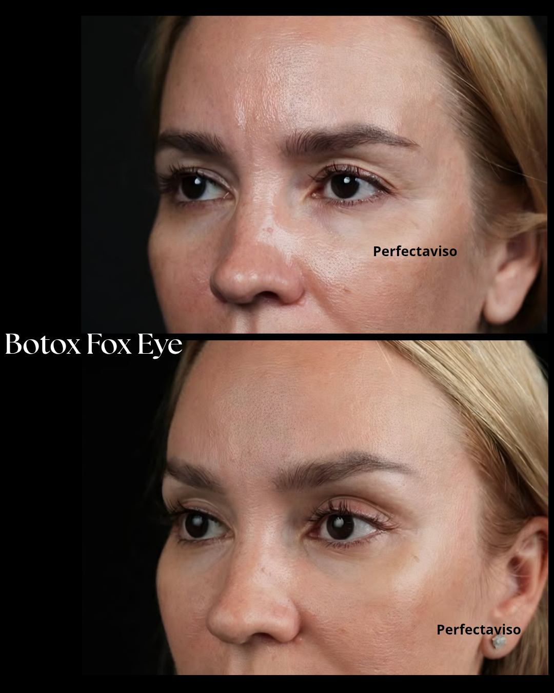 Botox Fox Eye : trattamento combinato tra Botox e laser alla palpebra eseguito dal Dr. Vincenzo Grippo a Napoli