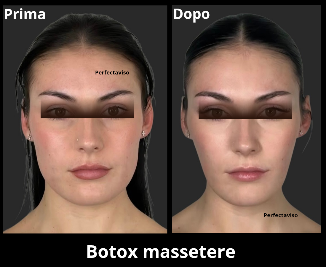 Botox Napoli: trattamento del muscolo massetere eseguito dal Dr.Vincenzo Grippo