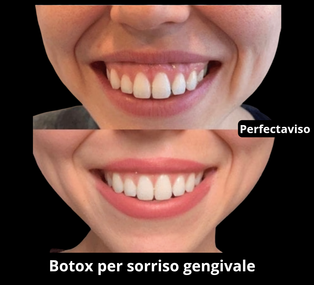 Trattamento con Botox del sorriso gengivale ( Gummy Smile) eseguito dal Dr.Vincenzo Grippo
