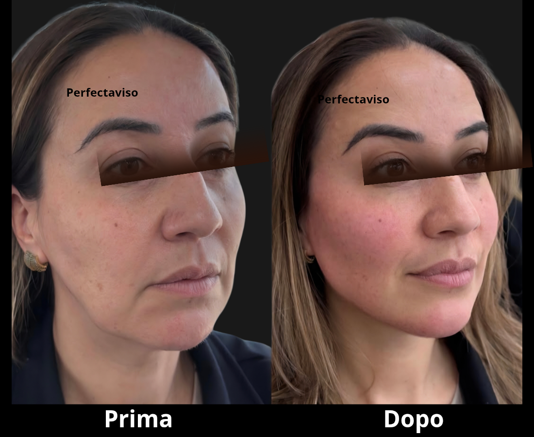 Full Face Napoli con Radiesse: miglioramento della lassità e definizione naturale