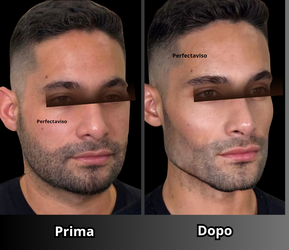 Radiesse Napoli: definizione del profilo mandibolare uomo eseguita dal Dr.Vincenzo Grippo