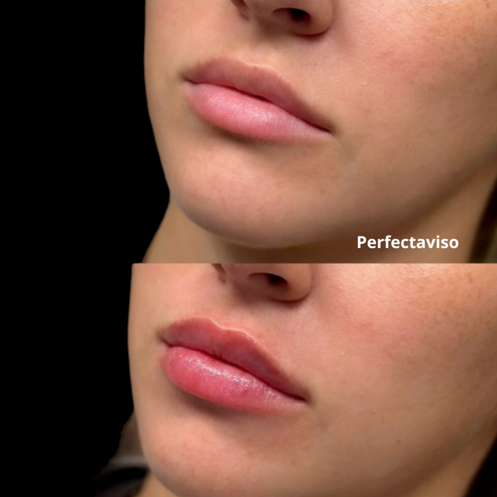 Filler labbra Napoli aumento naturale del volume