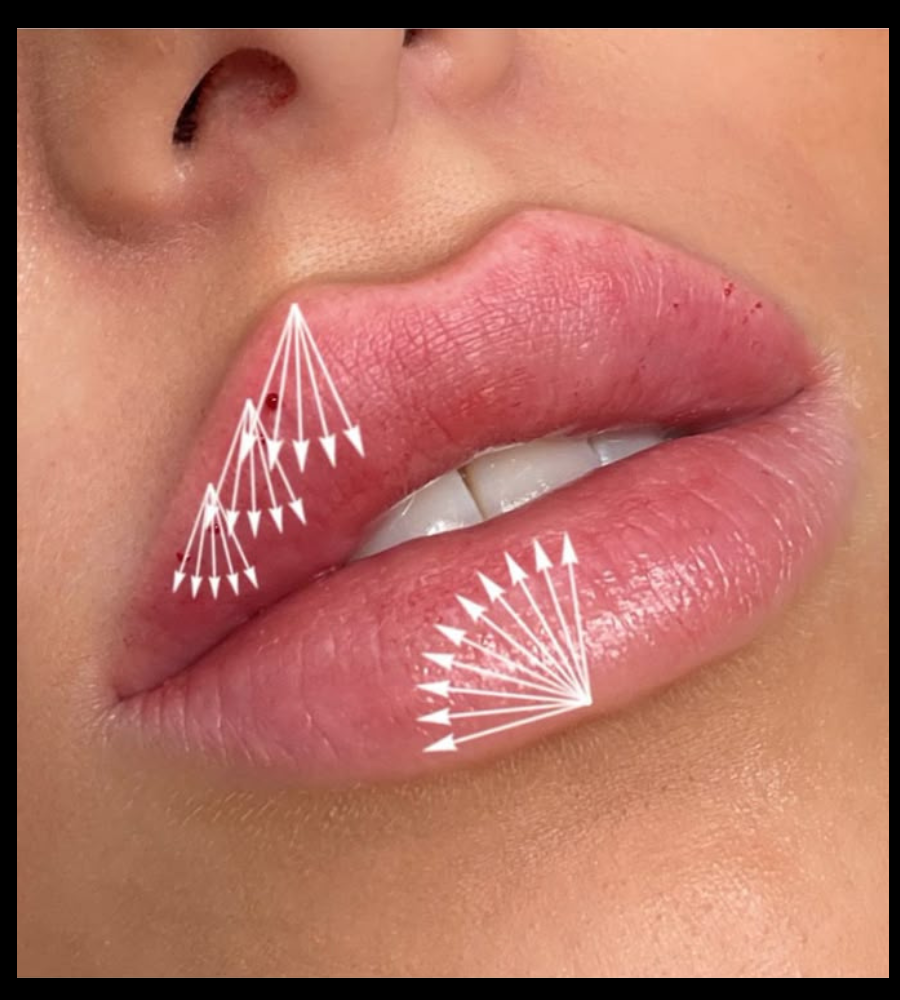 Mappatura della tecnica Russian Lip per filler labbra a Napoli